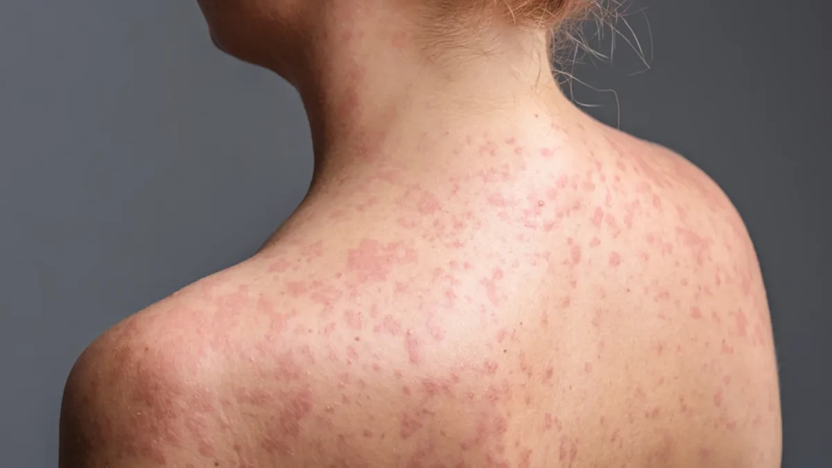 İstanbul'da Kızamık Vakaları Artışta: Yetişkinler de Risk Altında